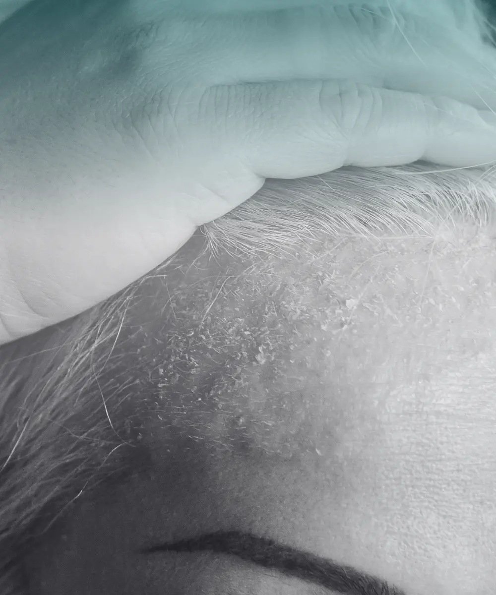 Seborrhoeic Dermatitis