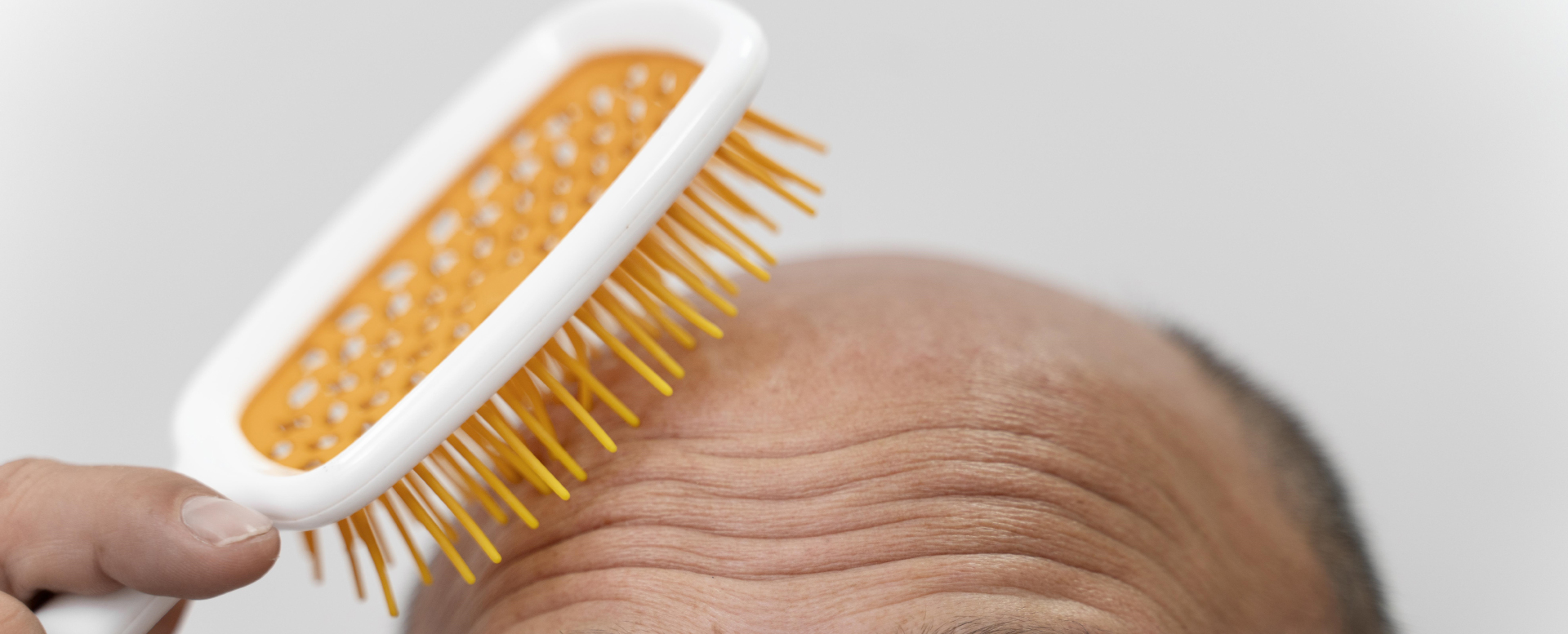 Oral Finasteride Vs. Topical Finasteride - What's the Difference?